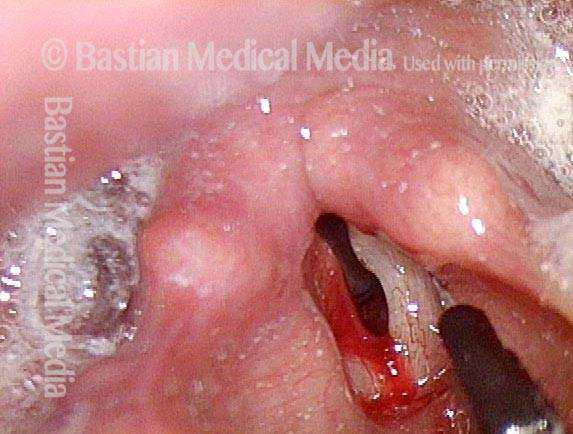 Vocal Fold Injections or Implants for Paralysis