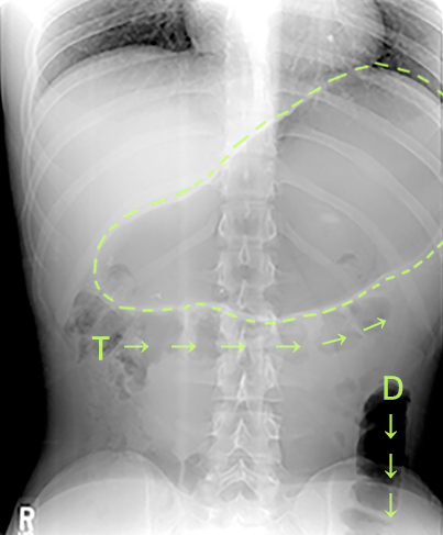 X-ray of chest with trapped air due to R-CPD