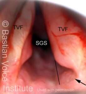 Post-intubation injury