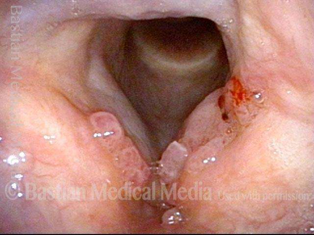RRP on true and false vocal cords